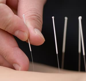 acupuncture IMS in Alliston