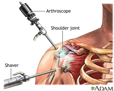arthroscopic shoulder surgery