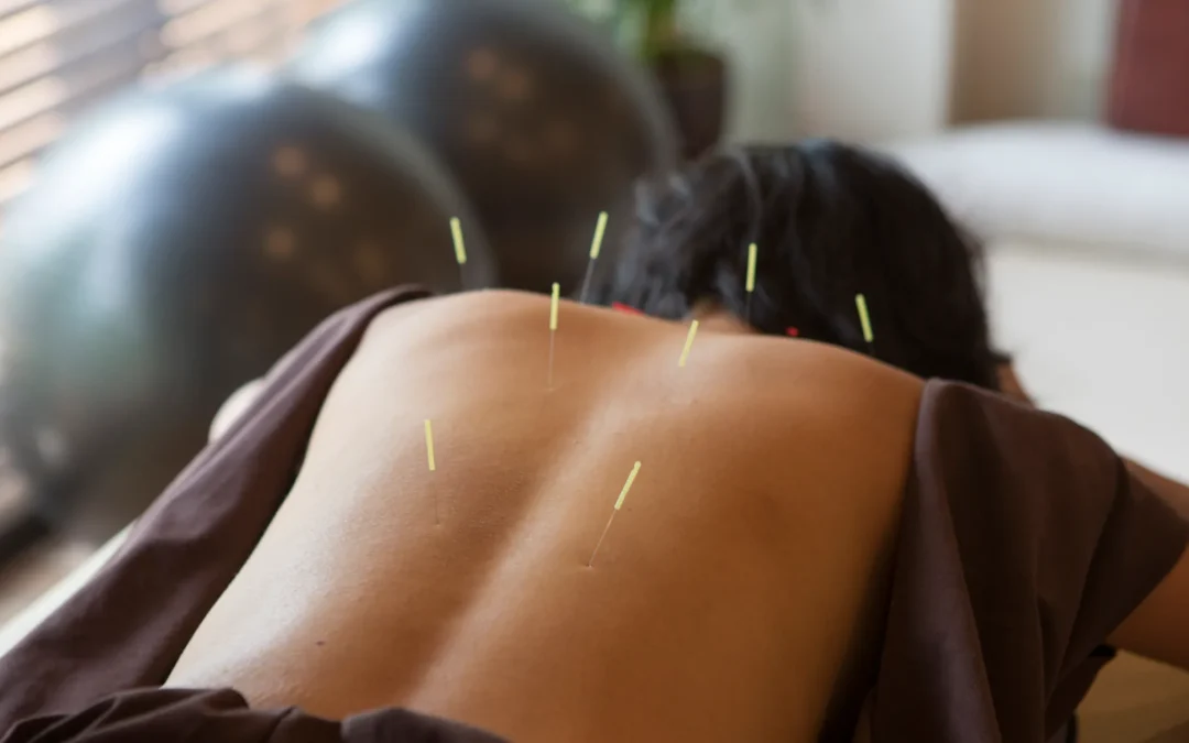 What is acupuncture and how can it help relieve my pain?