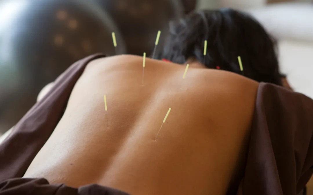 What is acupuncture and how can it help relieve my pain?