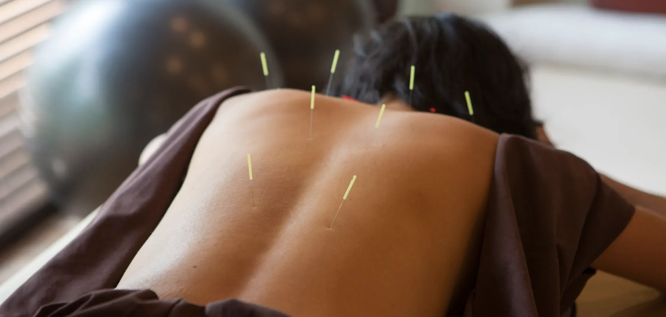 Acupuncture session at South Simcoe Physio for effective pain relief in Alliston and Tottenham, focusing on holistic healing Acupuncture session at South Simcoe Physio for effective pain relief in Alliston and Tottenham, focusing on holistic healing