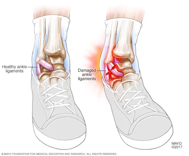 ankle sprain diagram