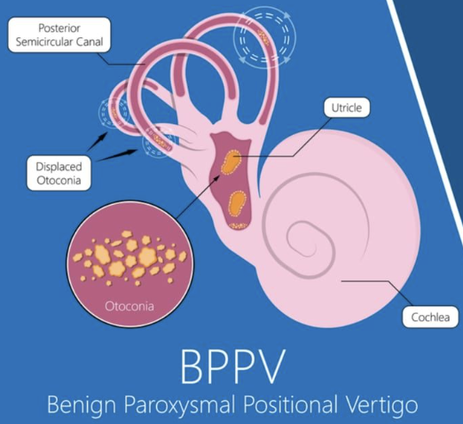 BPPV graphic