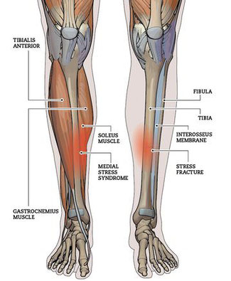 causes medial tibial stress syndrome or shin splints South Simcoe Physiotherapy Tottenham Alliston causes medial tibial stress syndrome or shin splints South Simcoe Physiotherapy Tottenham Alliston