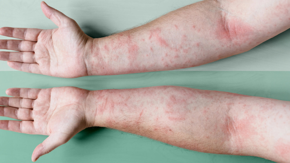 Severe eczema rash on forearms with red, inflamed patches Severe eczema rash on forearms with red, inflamed patches