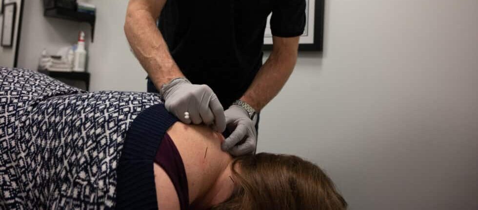 Acupuncture session demonstrating needle placement for pain relief in Alliston and Tottenham areas Acupuncture session demonstrating needle placement for pain relief in Alliston and Tottenham areas